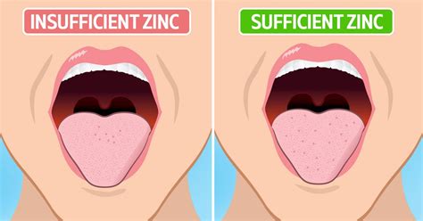 Bad taste in mouth: Symptoms, causes, and treatment .